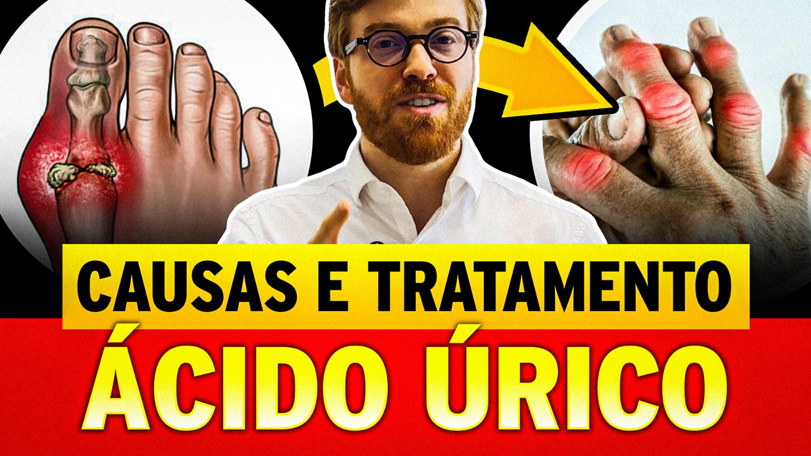 Gota e Ácido Úrico: Tudo Que Você Precisa Saber!