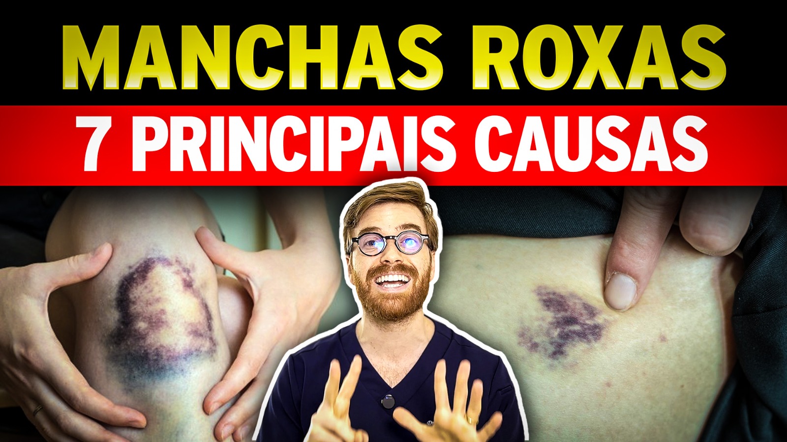 Manchas Roxas na Pele ALERTA para 3 Situações Graves!