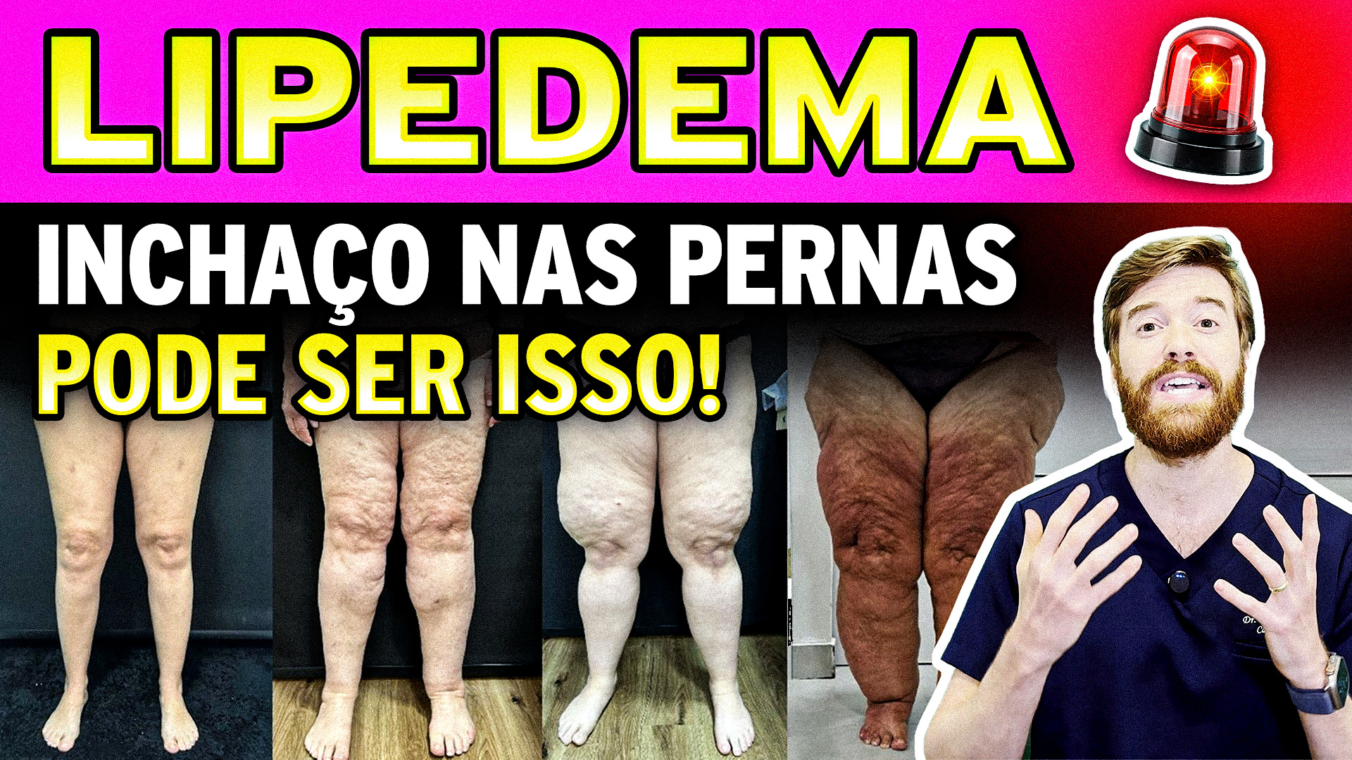 Lipedema: Entenda essa condição que afeta milhões de mulheres e muitas vezes passa despercebida