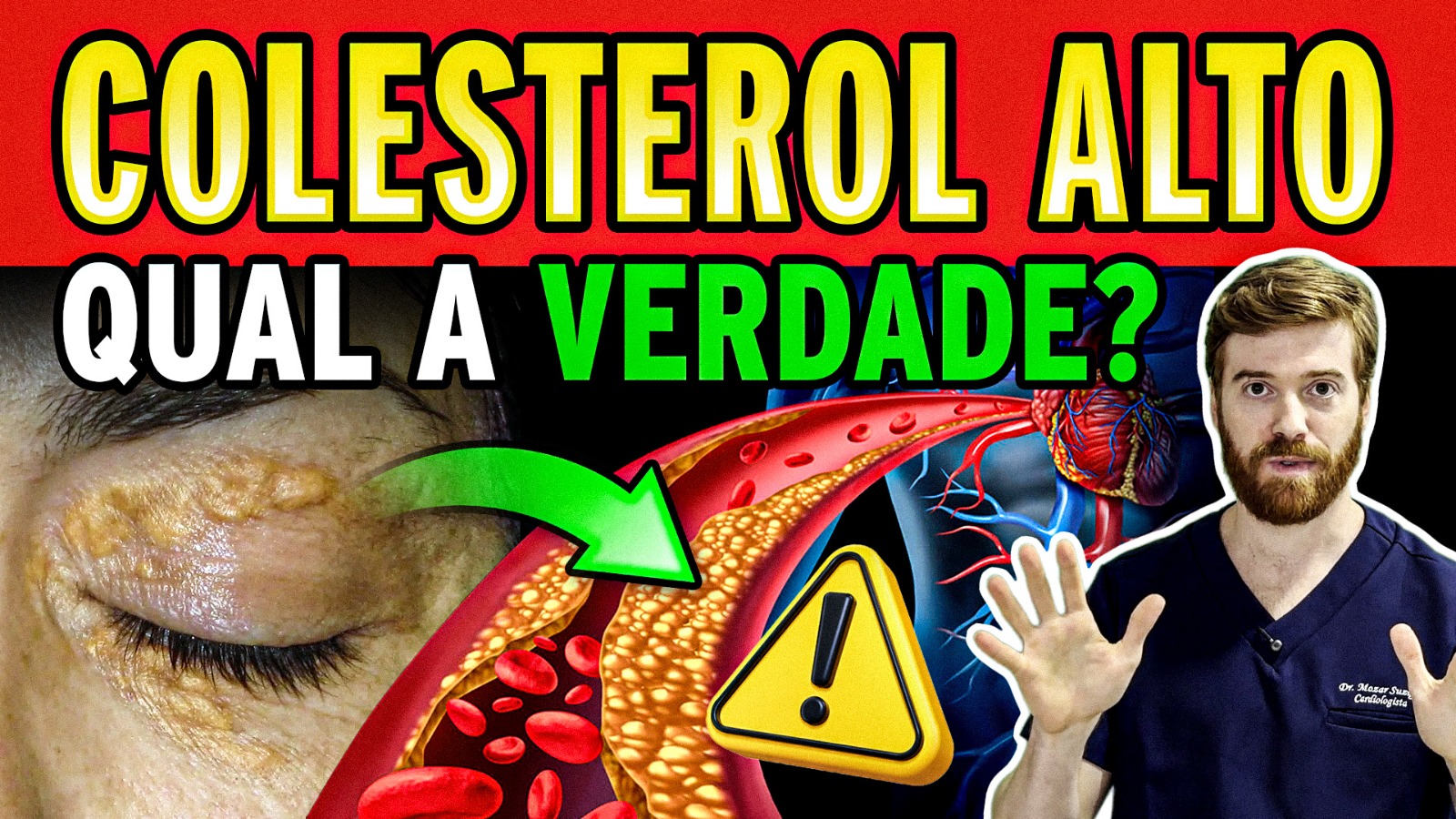 COLESTEROL: Tudo o que NINGUÉM EXPLICA (Genética, Remédios, Demência, Hormônios, Placas e Riscos)