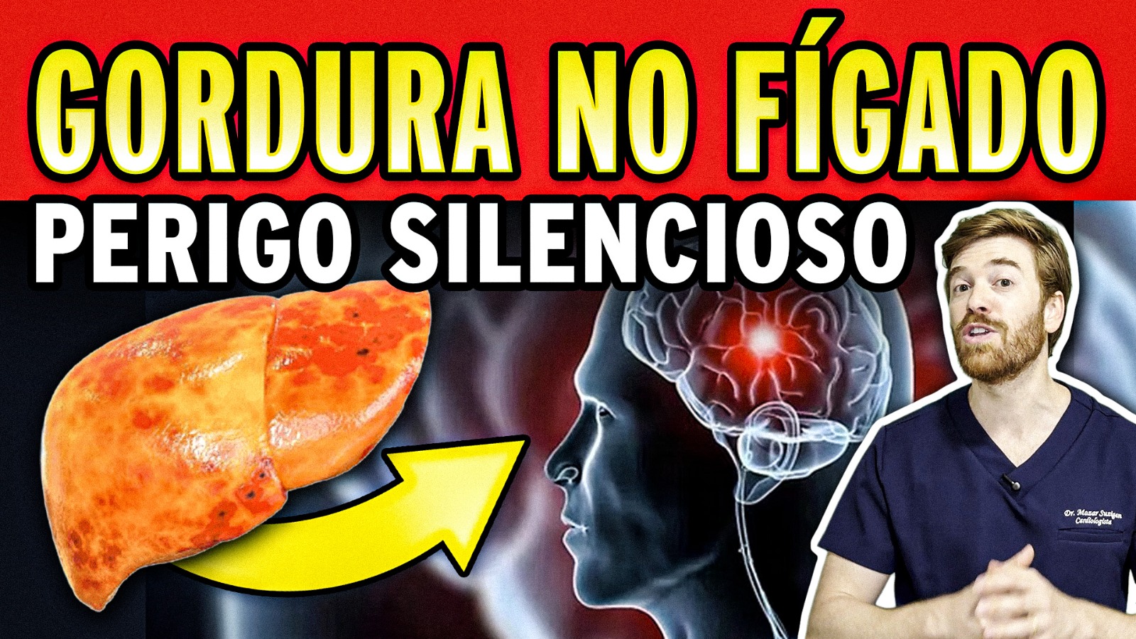Gordura no Fígado: Fuja desse Erro Silencioso que Aumenta Câncer, AVC, Infarto e Cirrose.
